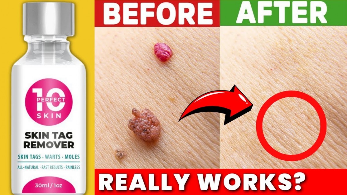 Perfect 10 Skin Tag Remover Scam OR Legit Nadaderm Skin Tag Remover