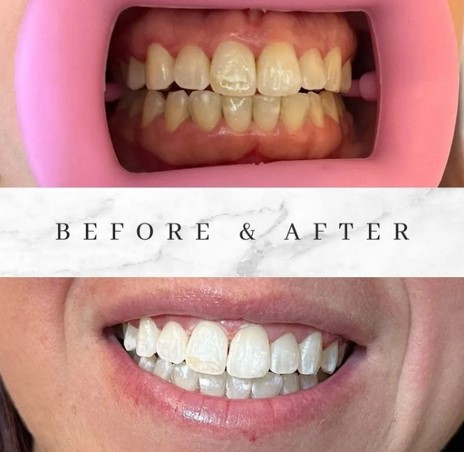 Before and After Before and After