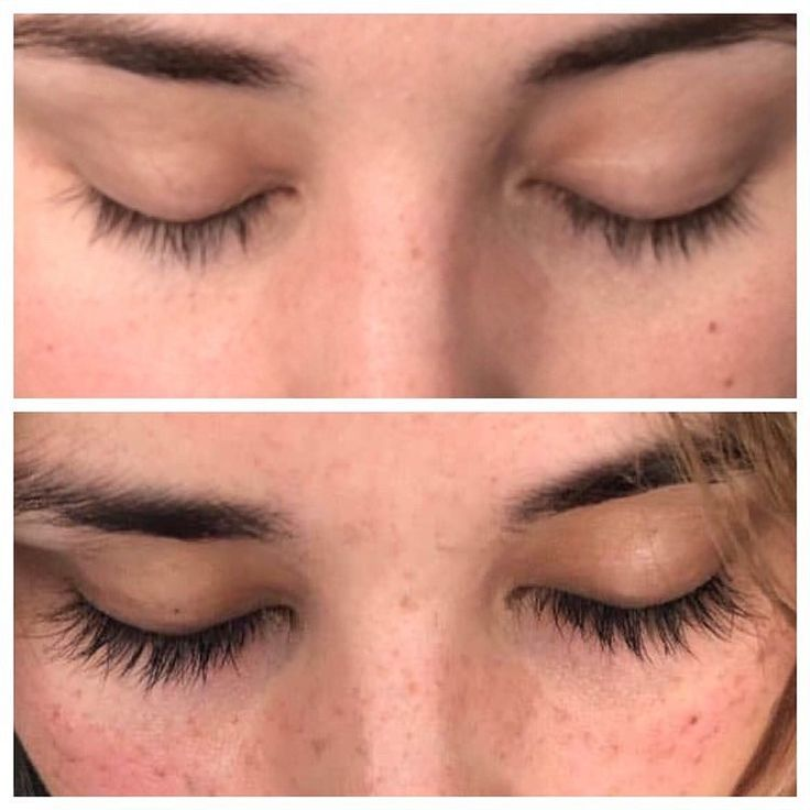 Before & After Careprost Eye Drops from Skinorac